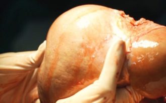 Primeiro explante de órgão para doação marca um novo capítulo para a saúde de Itaboraí (4)