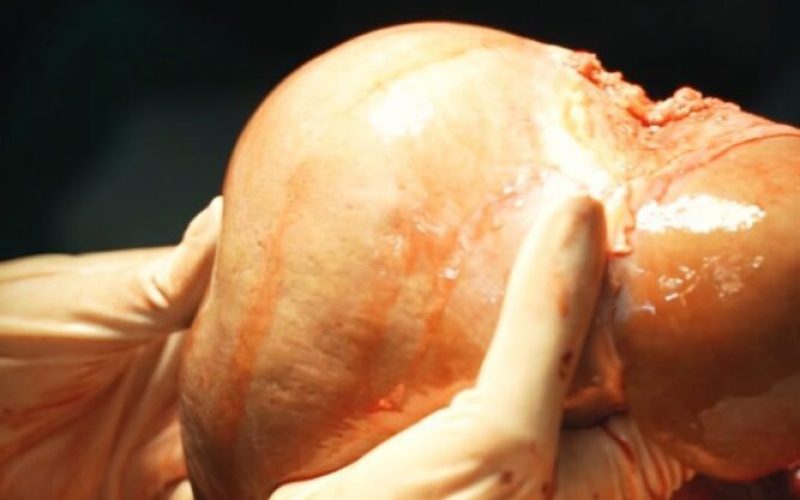 Primeiro explante de órgão para doação marca um novo capítulo para a saúde de Itaboraí (4) Primeiro explante de órgão para doação marca um novo capítulo para a saúde de Itaboraí (4)